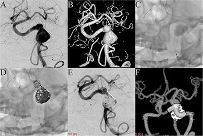 Pipeline Embolization Device With Adjunctive Coils for the Treatment of Unruptured Large or Giant Vertebrobasilar Aneurysms: A Single-Center Experience